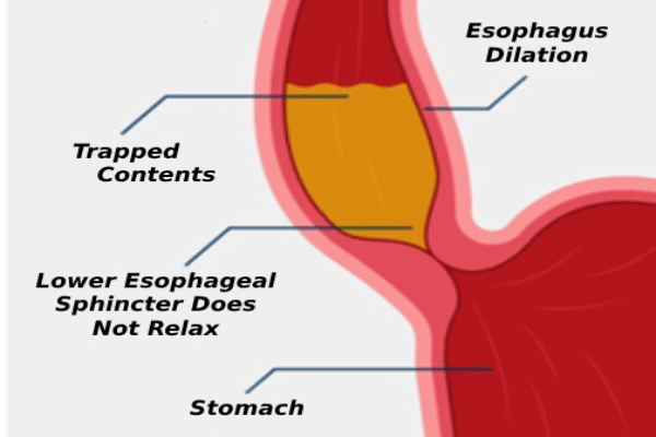 Diagram showing achalasia of the esophagus with trapped food contents, esophageal dilation, and a lower esophageal sphincter that does not relax — treated effectively with robotic surgery treatment in Coimbatore- Dr. K Balu