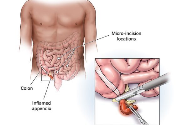 Appendicitis (Appendectomy) Gastrointestinal Surgery