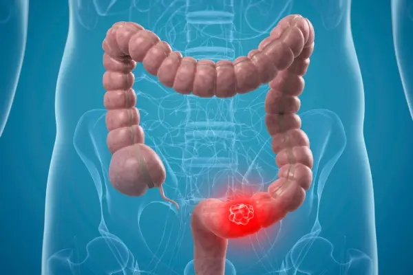 Best Colon Cancer Treatment in Coimbatore - Dr. K. Balu