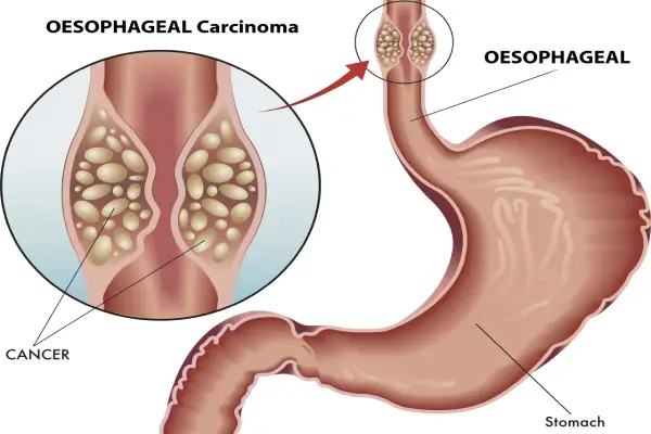 Esophageal Cancer