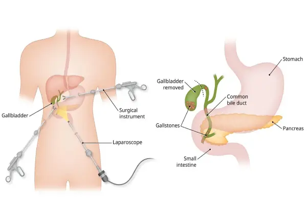 Gallbladder Stone Removal (Cholecystectomy) treatment in Coimbatore - Dr K Balu