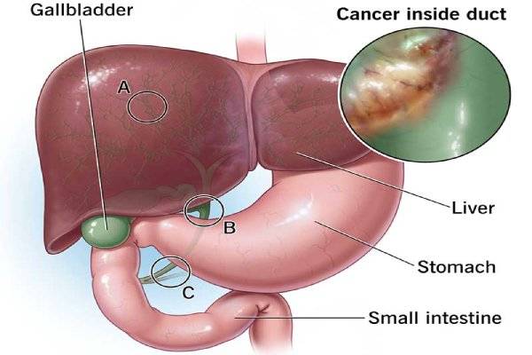 Hepatobiliary (Liver and Gallbladder) Cancers