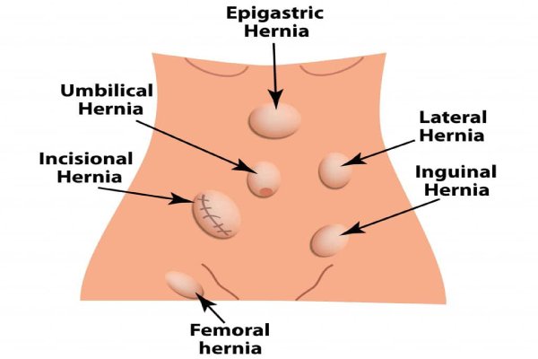 Hernias (Inguinal, Umbilical, Incisional)