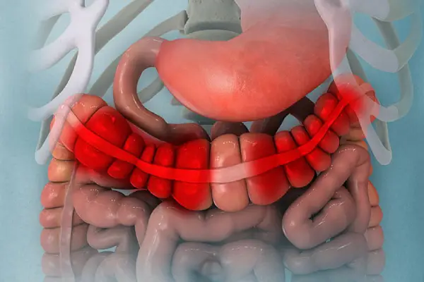 IBD Disease Treatment in Coimbatore- Dr. K. Balu