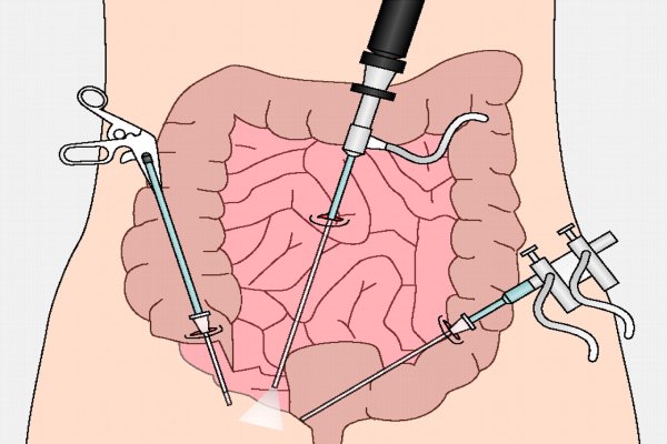 Laparoscopic Colorectal Surgeries