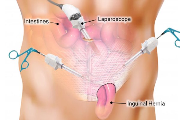 Laparoscopic Hernia Repair Treatment in Coimbatore by Dr. K. Balu – Minimally invasive surgery for inguinal hernia
