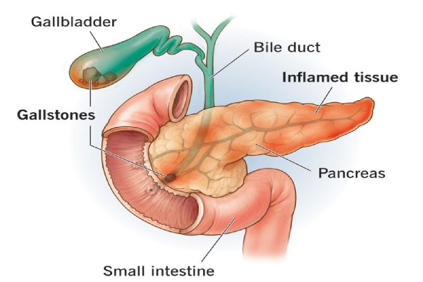Gallstones and Pancreatitis | Robotic Surgery Treatment in Coimbatore - Dr. K. Balu