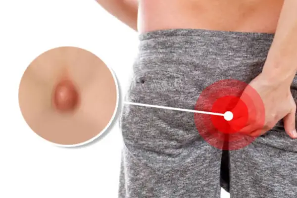 Best Pilonidal Sinus Treatment in Coimbatore | Pilonidal Sinus Specialist in Coimbatore - Dr. K. Balu