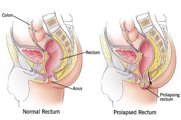 Showing rectal prolapse anatomy explained by Dr. K. Balu – robotic surgery treatment specialist in Coimbatore.