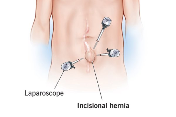 Incisional Hernia Repair | Robotic Surgery Treatment in Coimbatore - Dr. K. Balu