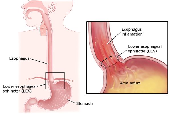 Severe Gastroesophageal Reflux Disease (GERD) Robotic GI Surgery Treatment in Coimbatore - Dr. K. Balu