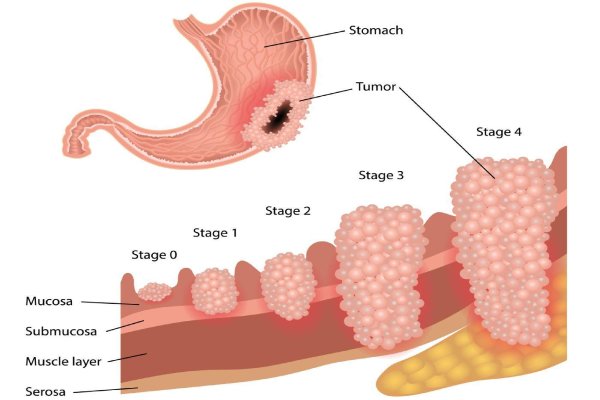 Stomach Cancer (Gastric Cancer)