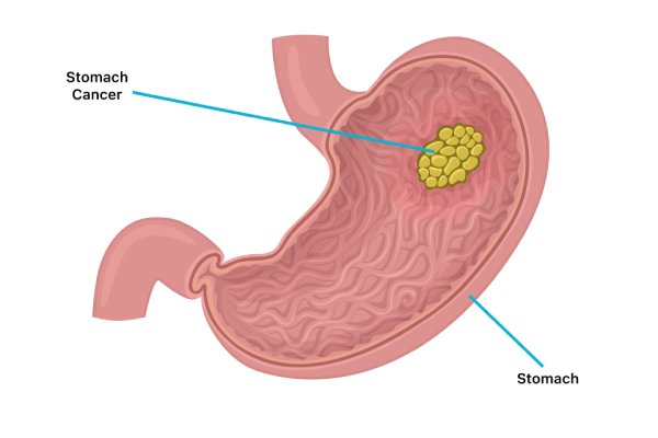 stomach cancer showing tumor growth inside the stomach, related to robotic surgery treatment for gastrointestinal tumors in Coimbatore by Dr. K. Balu.