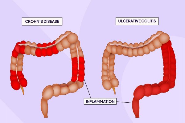 Medical illustration comparing Crohn’s disease and ulcerative colitis showing intestinal inflammation, explained by Dr. K. Balu – expert in robotic surgery treatment in Coimbatore.
