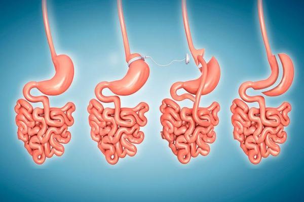 Gastric Bypass Surgery