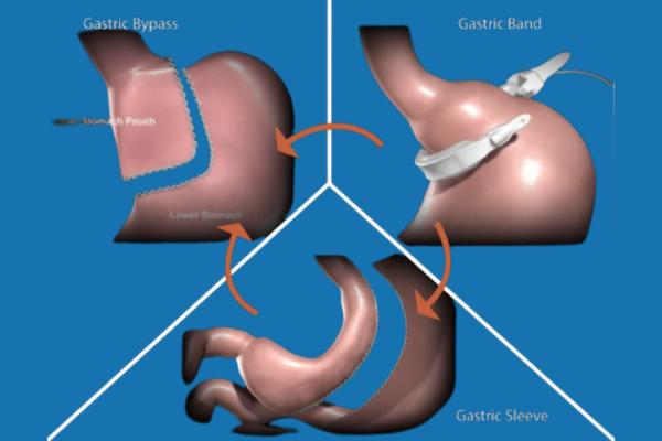 Revisional Bariatric Surgery