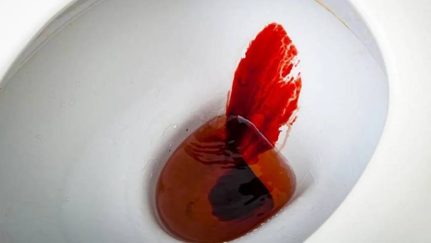 Blood in stool indicating possible gastrointestinal bleeding