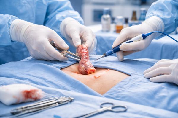 Appendix treatment surgery performed using advanced surgical techniques in Coimbatore by Dr. K. Balu