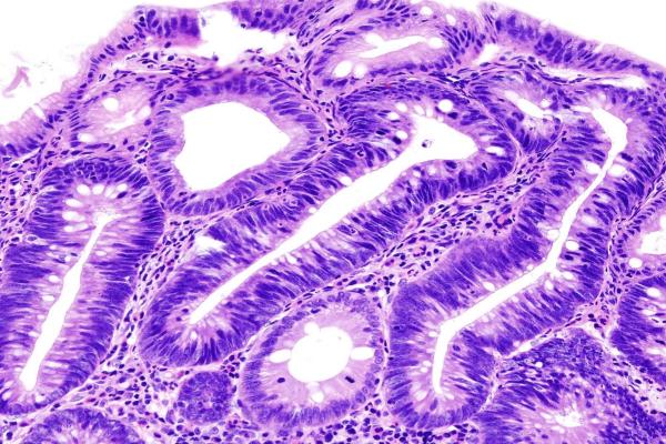 Adenomatous Polyps Adenomas