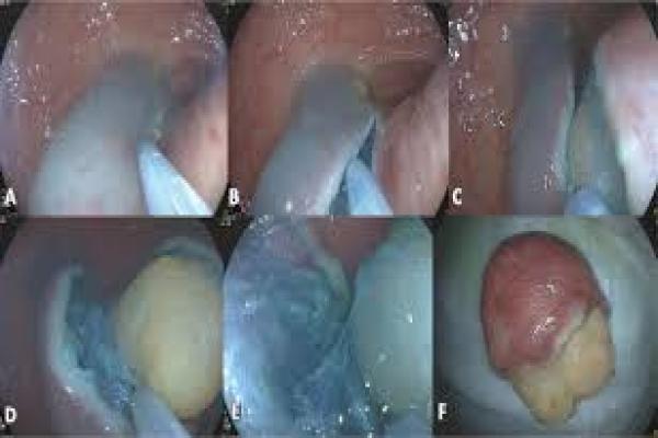 Advanced Endoscopic Removal — EMR and ESD