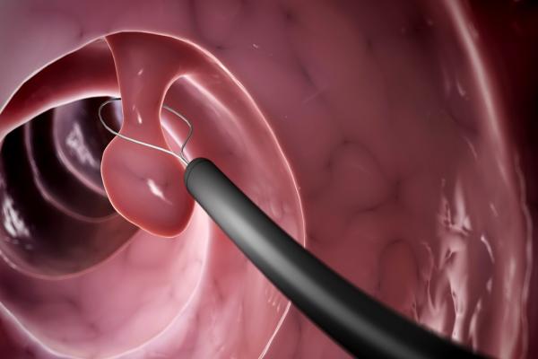 Colonoscopic Polypectomy