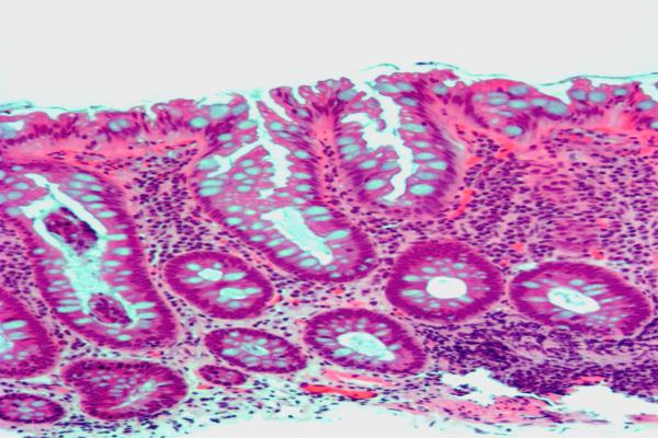 Hyperplastic Polyps