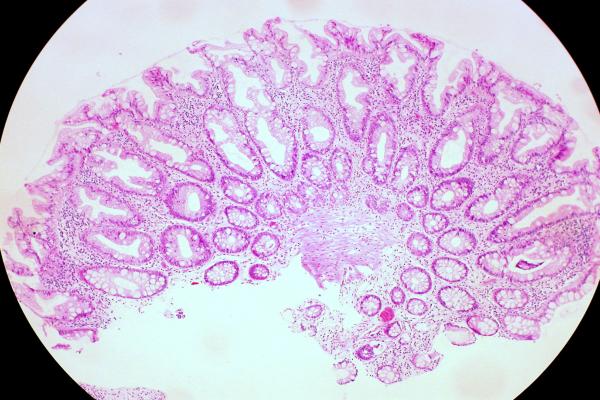 Serrated Polyps