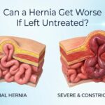 Can a Hernia Get Worse If Left Untreated?